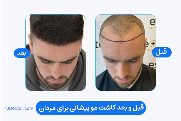 کاشت مو پیشانی مردان