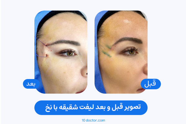 تصویر قبل و بعد لیفت شقیقه با نخ