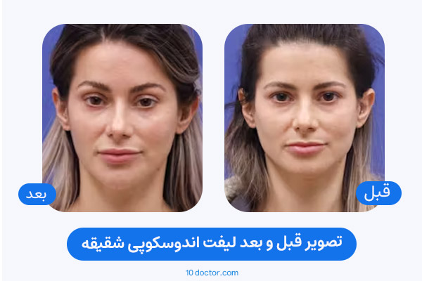 تصویر قبل و بعد لیفت اندوسکوپی شقیقه