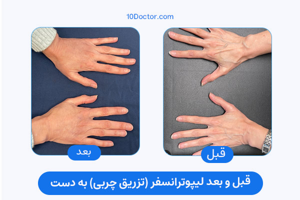 قبل و بعد لیپوترانسفر (تزریق چربی) به دست