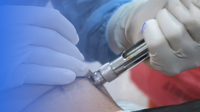 آمپول بی حسی کاشت مو درد دارد؟