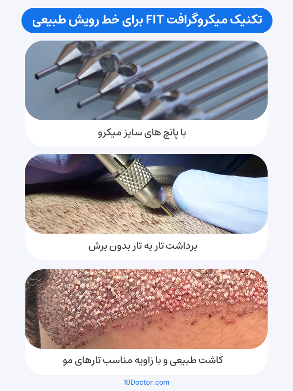 تکنیک میکروگرافت FIT برای خط رویش طبیعی
