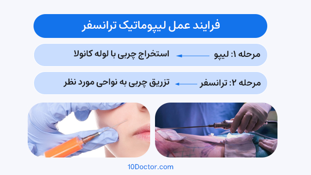 فرایند عمل لیپوماتیک ترانسفر