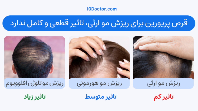 قرص پریورین برای ریزش مو ارثی، تاثیر قطعی و کامل ندارد. 