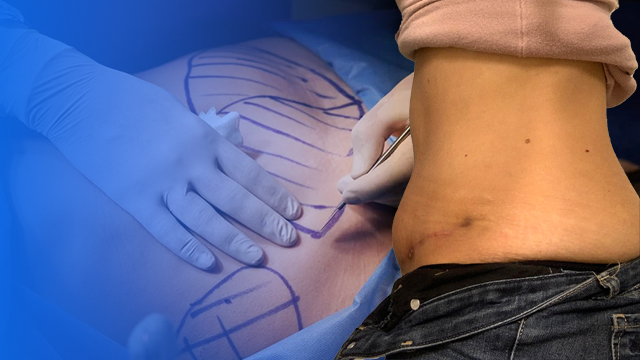 ورم بعد از ابدومینوپلاستی