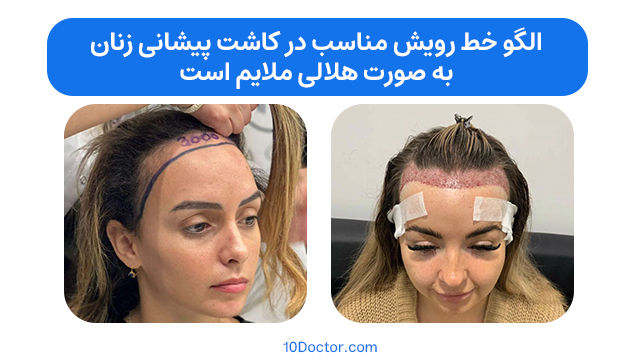 الگو خط رویش مناسب در کاشت مو پیشانی زنان، به صورت هلالی ملایم است.