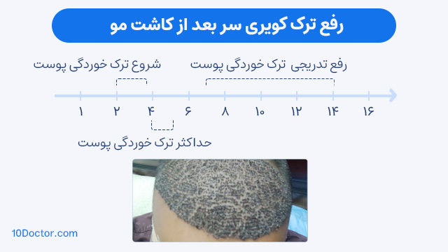 رفع ترک کویری سر بعد از کاشت مو