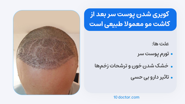 کویری شدن پوست سر بعد از کاشت مو معمولا طبیعی است.