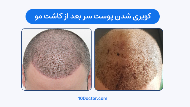 کویری شدن پوست سر بعد از کاشت مو