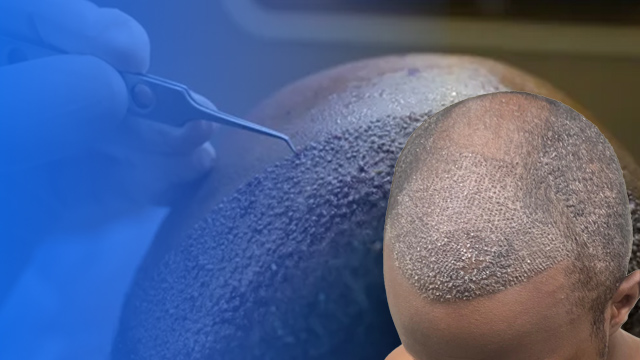 کویری شدن پوست سر بعد از کاشت مو