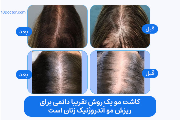 کاشت مو یک روش تقریبا دائمی برای ریزش مو آندروژنیک زنان است.