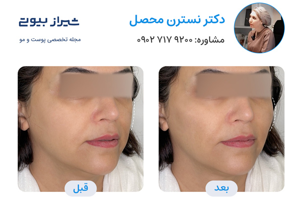 تزریق مزوژل در شیراز - دکتر نسترن محصل