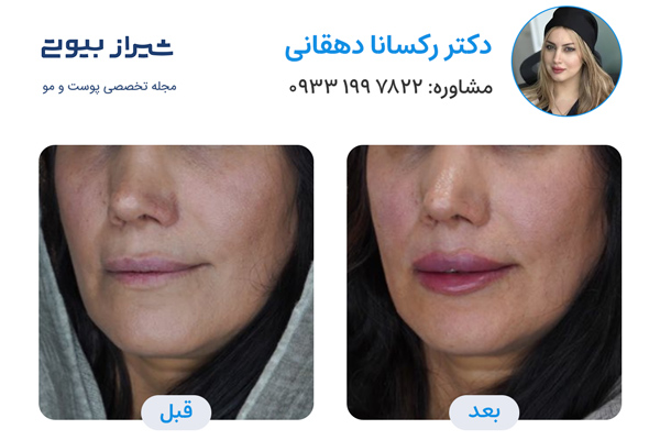 تزریق مزوژل در شیراز - دکتر رکسانا دهقانی