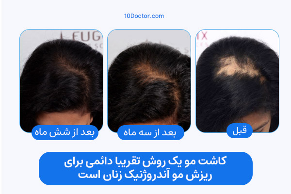 کاشت مو یک روش تقریبا دائمی برای ریزش مو با الگوی مردانه در زنان است.