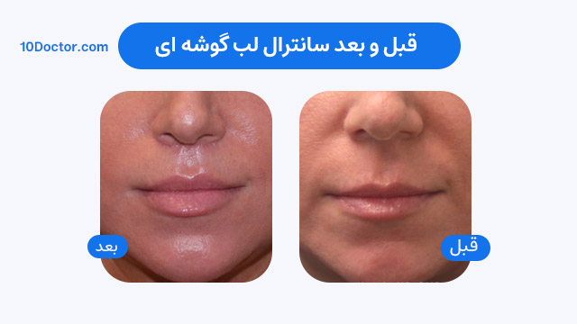 قبل و بعد سانترال لب گوشه ای