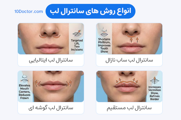 انواع روش های سانترال لب