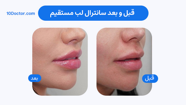 قبل و بعد سانترال لب مستقیم