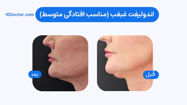 اندولیفت غبغب (مناسب افتادگی متوسط) 