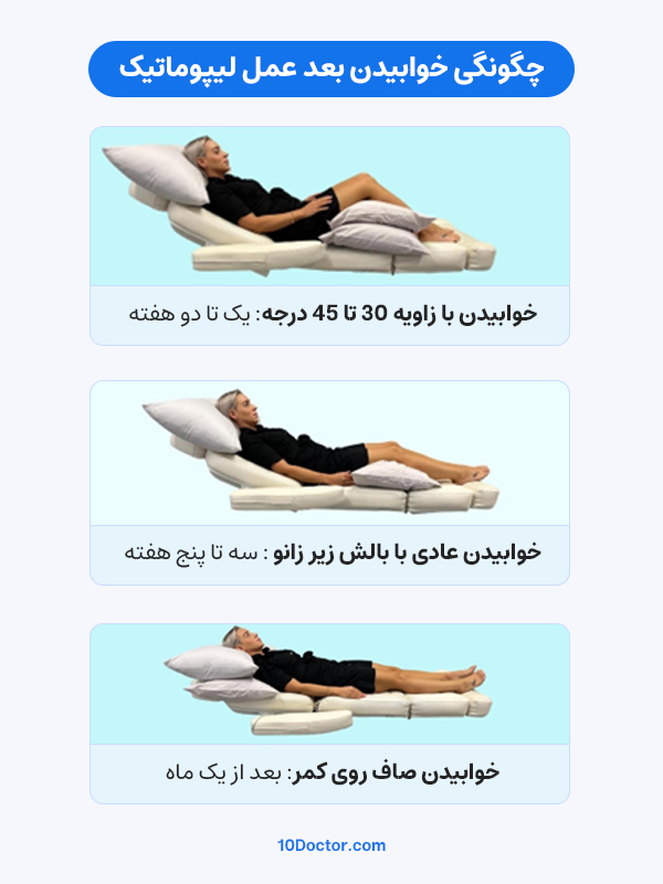 چگونگی خوابیدن بعد عمل لیپوماتیک