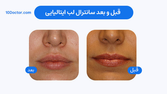 قبل و بعد سانترال لب ایتالیایی