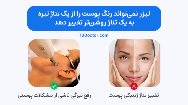 لیزر نمی‌تواند رنگ پوست را از یک تناژ تیره به یک تناژ روشن‌تر تغییر دهد.