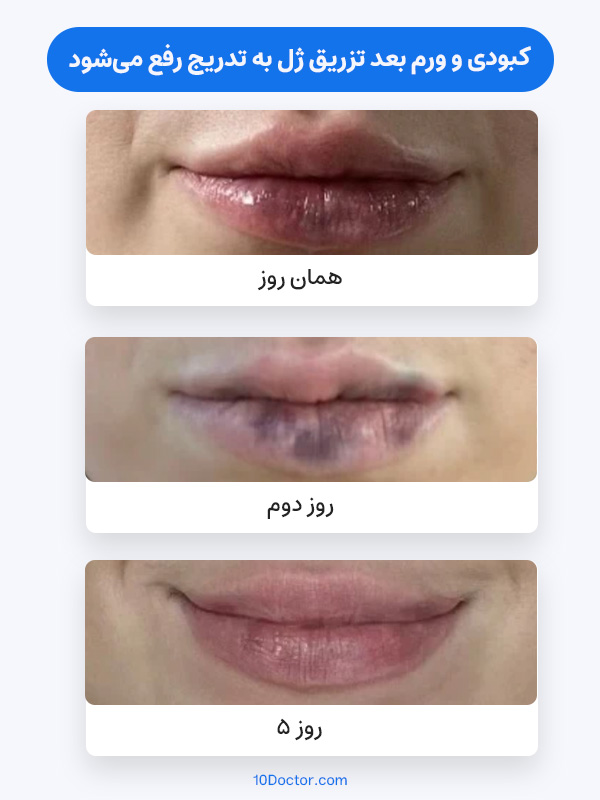 کبودی و ورم بعد تزریق ژل به تدریج رفع می‌شود.