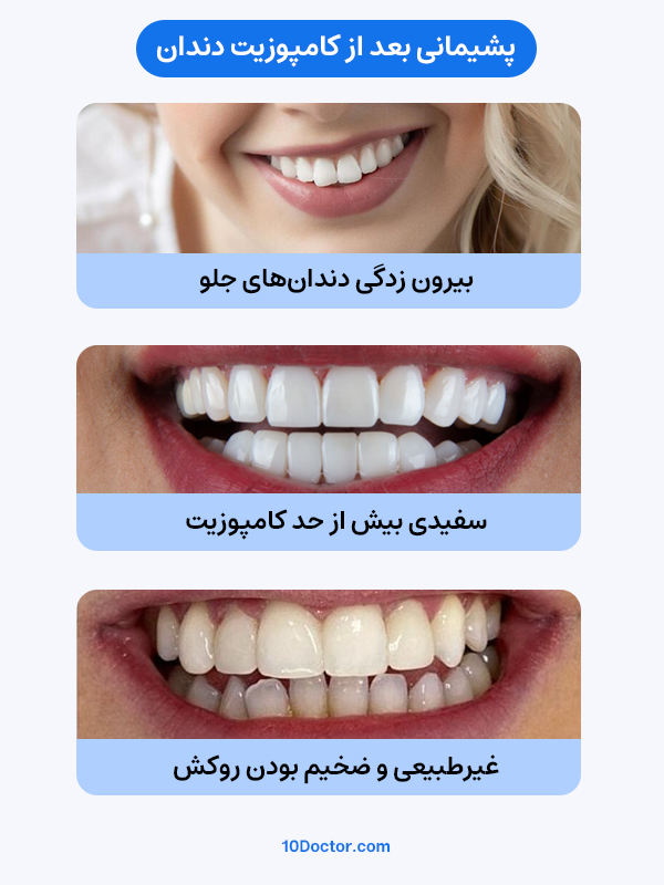 علت پشیمانی بعد از کامپوزیت دندان