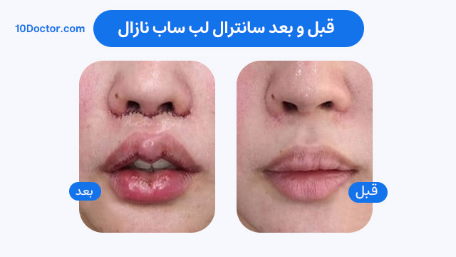 قبل و بعد سانترال لب ساب نازال