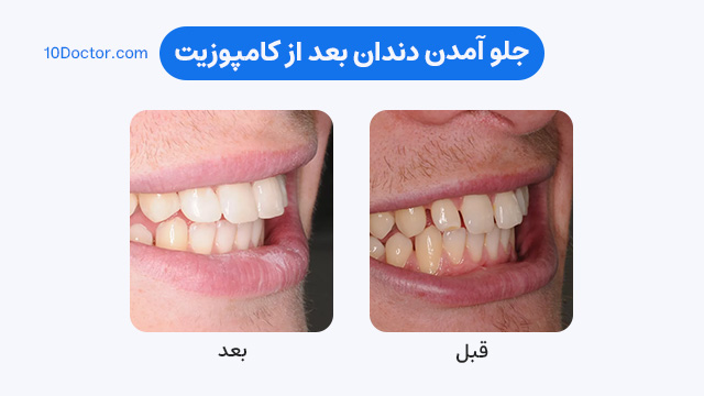 جلو آمدن دندان بعد از کامپوزیت