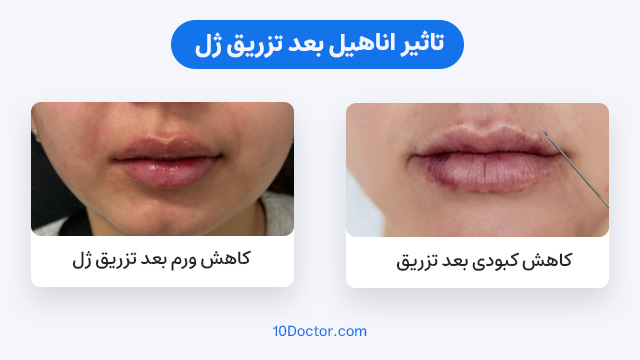 تاثیر اناهیل بعد تزریق ژل