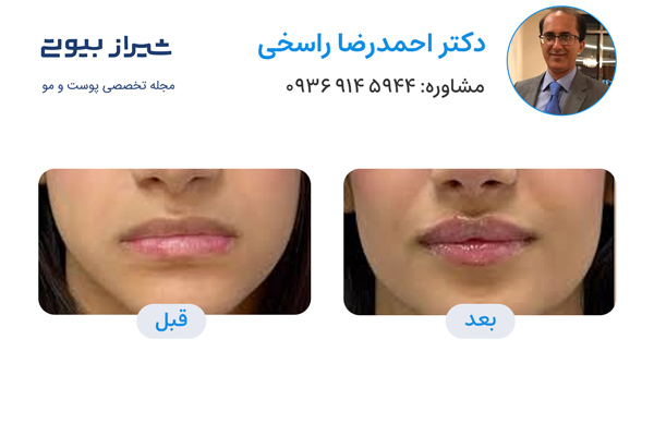 سانترال لب در شیراز - دکتر احمدرضا راسخی تصاویر قبل و بعد