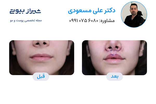 سانترال لب در شیراز - دکتر علی مسعودی تصاویر قبل و بعد