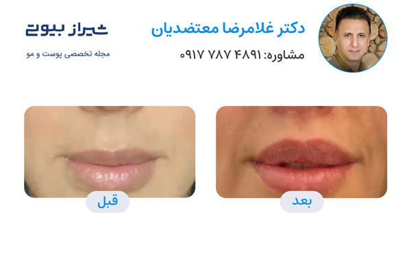 سانترال لب در شیراز - دکتر غلامرضا معتضدیان تصاویر قبل و بعد