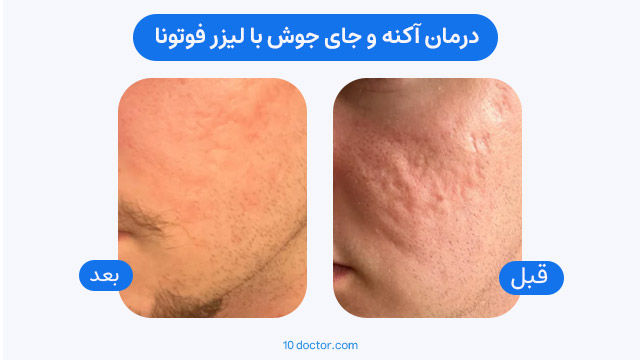 درمان آکنه و جای جوش با لیزر فوتونا - قبل و بعد 1