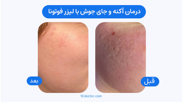 درمان آکنه و جای جوش با لیزر فوتونا - قبل و بعد 2