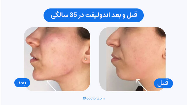 عکس قبل و بعد اندولیفت در 35 سالگی
