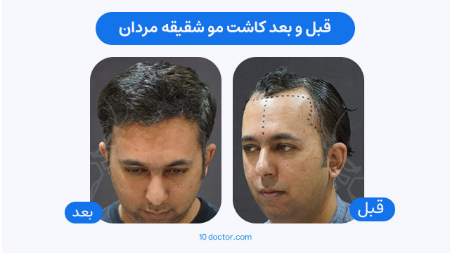 قبل و بعد کاشت مو شقیقه مردان