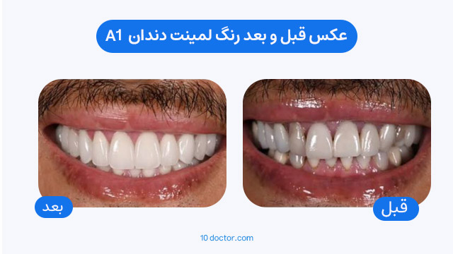 عکس قبل و بعد رنگ لمینت دندان  A1