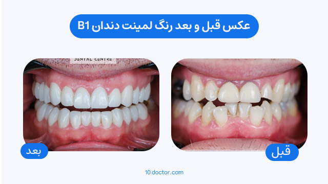 عکس قبل و بعد رنگ لمینت دندان b1