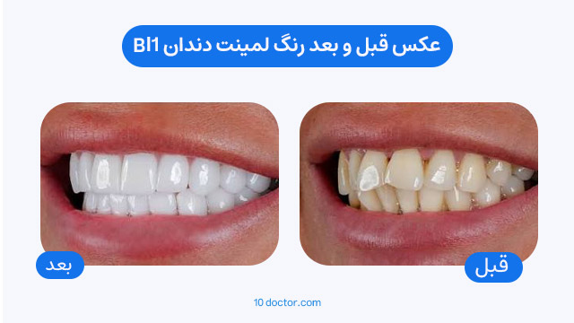 عکس قبل و بعد رنگ لمینت دندان bl1