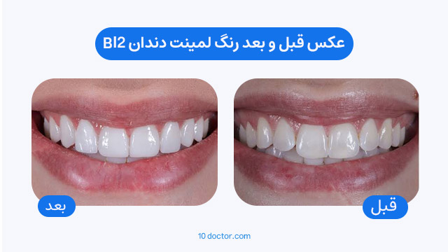 عکس قبل و بعد رنگ لمینت دندان bl2