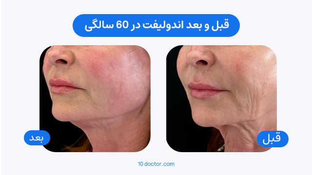 عکس قبل و بعد اندولیفت در 60 سالگی
