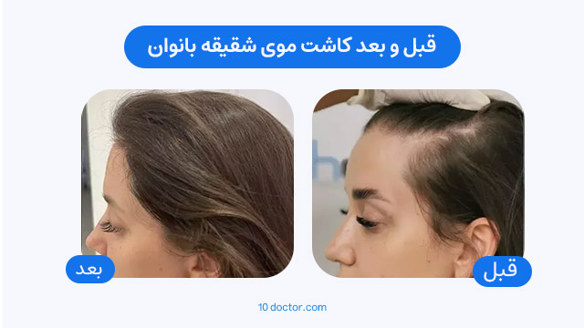 قبل و بعد کاشت موی شقیقه بانوان