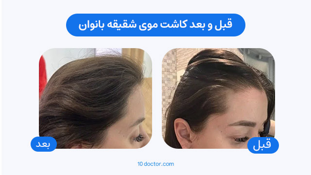 قبل و بعد کاشت موی شقیقه بانوان