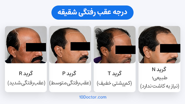 درجه عقب رفتگی شقیقه