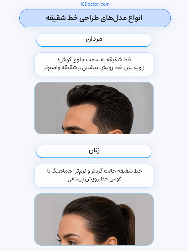 تفاوت طراحی خط شقیقه برای کاشت در مردان و زنان