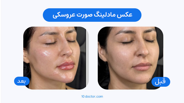 عکس مادلینگ صورت عروسکی