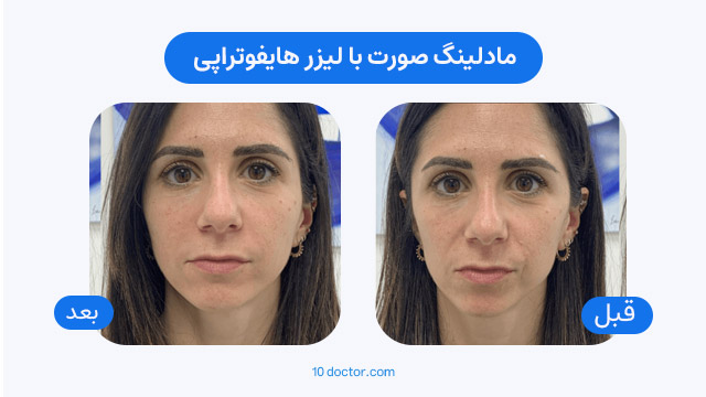 مادلینگ صورت با لیزر هایفوتراپی