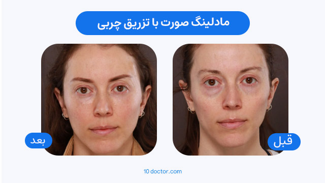 مادلینگ صورت با تزریق چربی