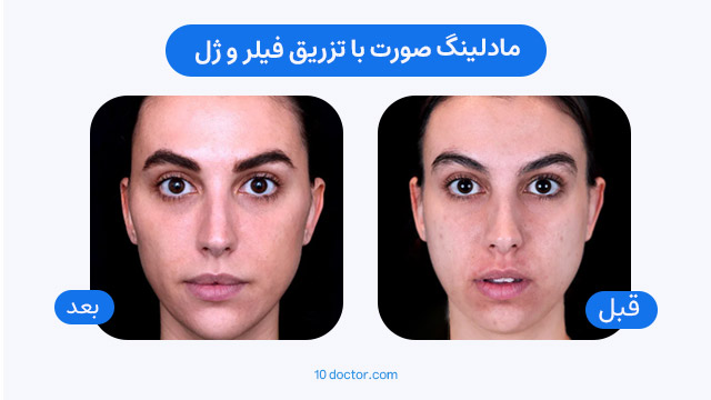 مادلینگ صورت با تزریق فیلر و ژل